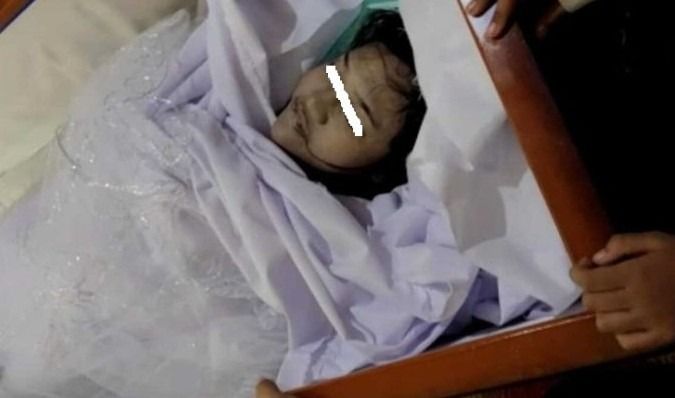 Ini Penyebab Ella Hasibuan Tewas Usai Sedot Lemak di Depok