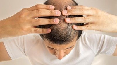 Dokter Ungkap Solusi Mencegah Kebotakan di Usia 30 an