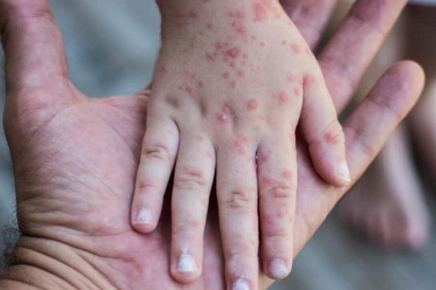 Mpox Belum Reda, WHO Tetap Nyatakan Status Darurat Global