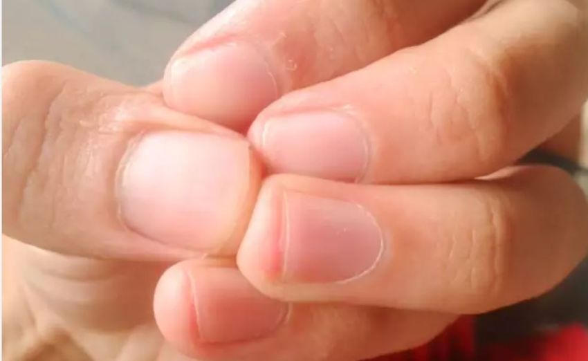 Kuku Bisa Jadi Indikator Kolesterol Tinggi, Kenali Gejalanya !