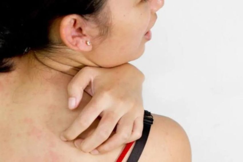 Kenapa Penderita Diabetes dan Obesitas Lebih Mudah Terkena Jamur Kulit?