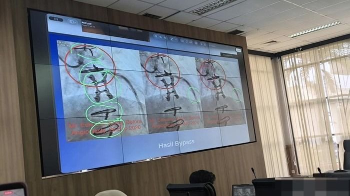 Kawat Tertinggal di Jantung, Dokter RSUD AWS Sengaja Demi Selamatkan Pasien?
